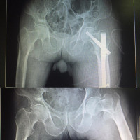 #femoral intertrochanteric #fracture treated well with proximal femoral nailing