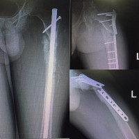 #femoral sub trochanter delayed union cause fracture with minor trauma,tried to do best.