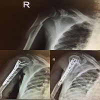 #nonunion of humerus after four months splint in 80 years old man,#plating helps patient to improve function.