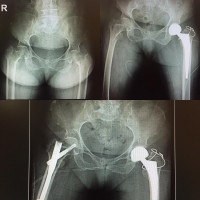 #bilateral inter trochanteric #fracture which right side covered by sever left side pain,and,discovered after left side #hemiarthroplasty