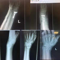 #distalradiusfracture malunion,it seems need distal ulnar procedure,but just correction of #dorsalangle corrected the #ulnarvariance,without any additional procedure