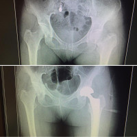#hemiarthroplasty is a simple and straightforward solution in #femoral neck
