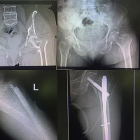 #intertrochantericfracture with greater trochanter fracture ,PFN is a stable device especially blade design,can start weight bearing immediately