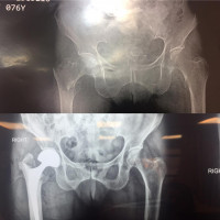 #hemiarthroplasty is a good option for Iranian unstable intertrochanteric fracture,especially old one