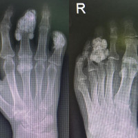 Before see below say,What are the differential diagnosis?
#scleroderma