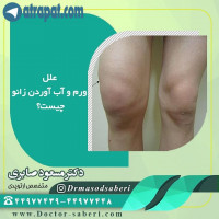 ☝علل ورم و آب آوردن زانو
استئوآرتروز و روماتیسم از شایع‌ترین علل ورم و آب آوردن مفصل زانو به شمار می‌روند. استئوآرتروز عارضه‌ای است که در اثر آن، بافت غضروف یا ضربه‌گیرهای داخل مفصل زانوی شما فرسوده شده و از بین می‌رود.
مصدومیت و آسیب‌دیدگی

ورم ناشی از آسیب‌دیدگی زانو و یا ورم زانوی کودک بعد از ورزش و بازی می‌تواند نشان‌دهنده آسیب‌دیدگی مینیسک یا رباط صلیبی قدامی در زانو باشد.
بیماری نقرس یکی از علل نه چندان شایع برای ورم دردناک در ناحیه مفصل زانو به شمار می‌رود.
عفونت
بیماری شبه نقرس (CPPD)

بیماری شبه نقرس نیز می‌تواند باعث متورم شدن مفصل زانو شود. درد ناشی از این عارضه معمولاً به شدت دردهای ناشی از نقرس یا استئوآرتروز شدید نیست.
#آب_آوردن_زانو #تعویض_مفصل_زانو #تعویضمفصل #متخصص_ارتوپدی_خوب #دکتر_صابری