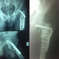 #nonunion of intertrochanteric fracture mainly treat with #Arthroplasty,but refixation is an option in selected patients.