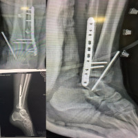 The main problem was old non reduced #syndesmosis,and surprisingly talus reduced with just fibular correcting,CT scan was very helpful.