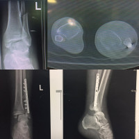A simple bimalleolar #fracture if does not reduce properly can due to #talar subluxation or dislocation.#CT scan is a main imaging in #malunion treatment to figure out surgery techniques.