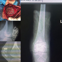 Cranial mesh fixation method for #patella.Am I crazy to fix this? I gave one chance to union and can't guess what will happen.
