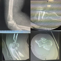 Capitellum #fracture undiagnosed after one month #openreduction was done.