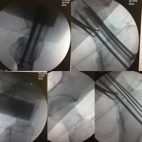In Femoral neck #fracture maintaining reduction is a debate,if you see there is a little medial gap during reduction will see,so medial screw  induced first,and it  compressed. As you see the thread of screws is not far from fracture line and it says performing fixation with Sliding hip screw might be difficult.