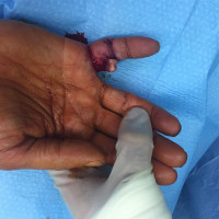#opendislocation of PIP means all of the #jointligaments was torn,its prognosis is poor.