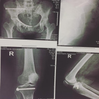 #percutaneous #fixation is one of the valuable methods,specially in #pelvic fracture