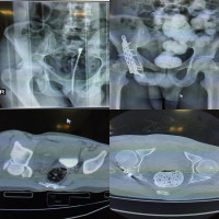 If you suspect to any screw penetration in #acetabularfracture get #postoperative CT Scan
