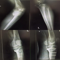 Type four #Schatzker tibial #platue fracture currently approaches from posteromedial for fixation