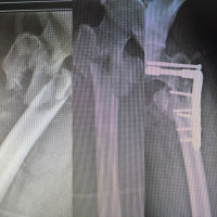 This is #subtrochantric missed hip fracture after one month in intensive care unit,if it wouldn't manage close,do it with plate which can get better reduction.