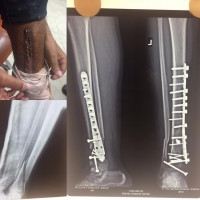 I will not never judge any #surgeon as I could not be in his skin at same condition,this photo and X-rays is belong to a foreign patient had operation in somewhere else,I was laughing at first but regretful now,I am not better surgeon than anyone.let the others say that.