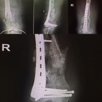 This is a young addicted man,When we face with unreducable #fracture we have to decide a difficult decision, just achieve #limblength  and #rotation near #anatomic and you'll wonder of healing as you see in bottom X-ray