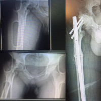 Previous #osteoarthritis of hip which injured and fractured due to lack of range of motion.might that treated with #Arthroplasty with long stem but it could be risky so affecting decision to fix