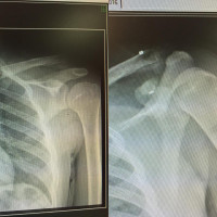 Acromioclavicular #dislocation before one month can be treated without reconstructing procedures.
Endobutton is the way that has minimal incision with satisfactory result.
