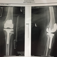 #knee Arthroplasty