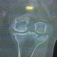 A tibial platue fracture with obvious sever #osteoarthritis can be treated with primary #Knee Arthroplasty,as I did