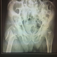This is 70 years old man after falling with reverse oblique(unstable) #intertrochanteric  fracture treated with proximal femoral #nailing